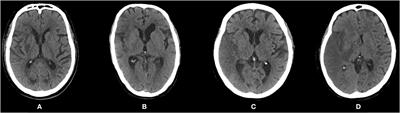 Association Between Post-procedure Cerebral Blood Flow Velocity and Severity of Brain Edema in Acute Ischemic Stroke With Early Endovascular Therapy